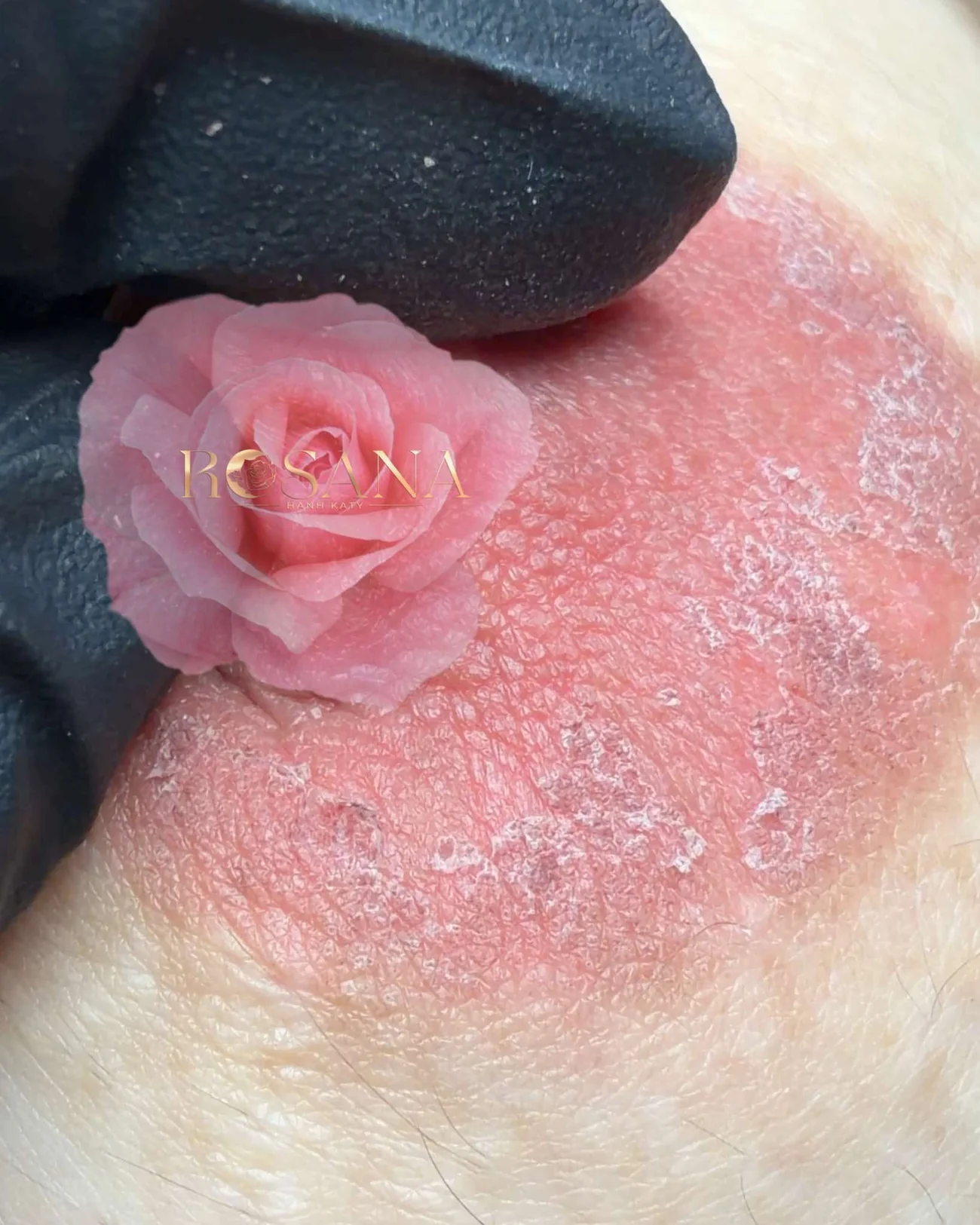 Giai đoạn gần bong sạch với Rosana