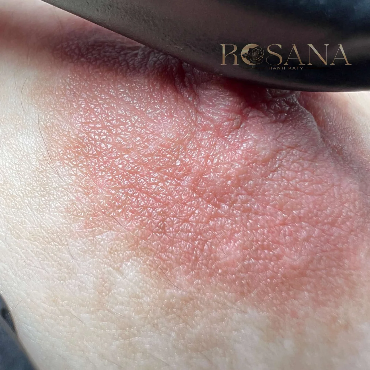 Một kết quả Rosana khác sau bong